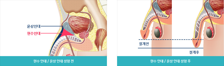 현수인대/ 윤상인대 성형